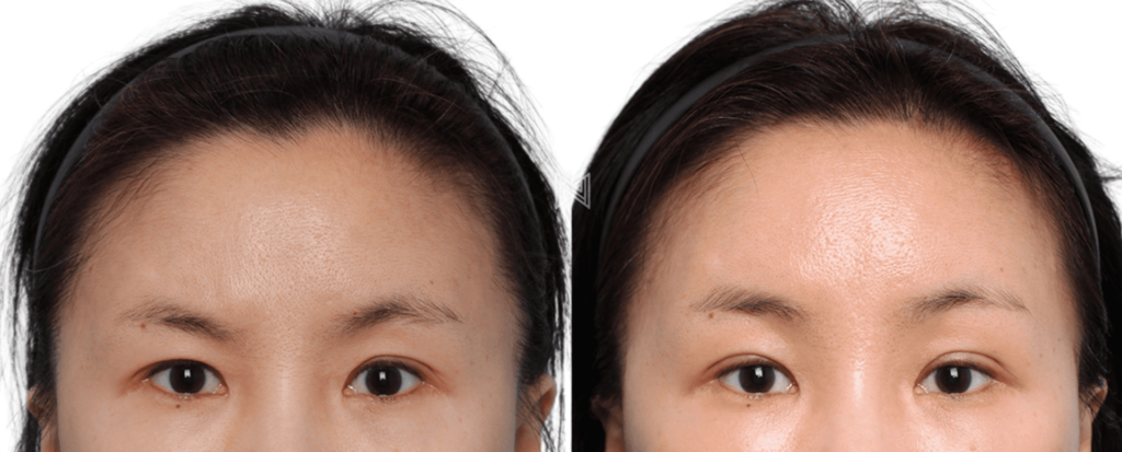 Forehead Lift Results in Korea