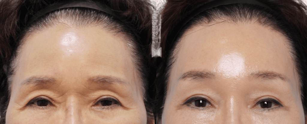 Forehead Lift Surgery Stages in Korea