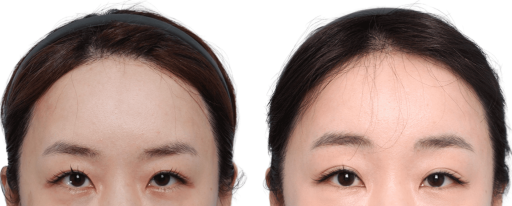 Forehead Lift Technique in Korea