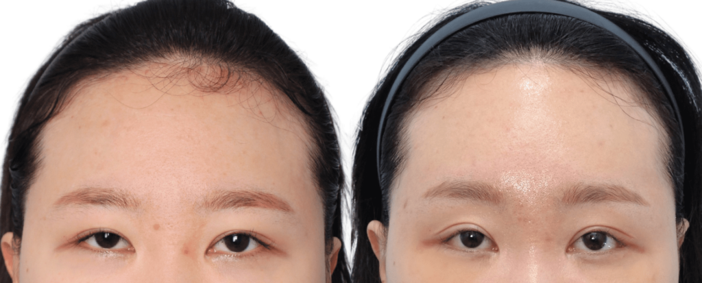 Forehead Lift for Men in Korea