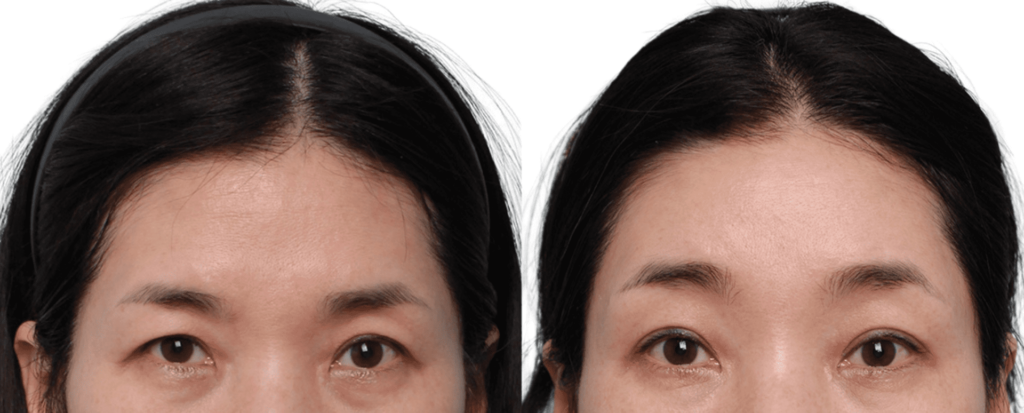 Forehead Lift for Women in Korea