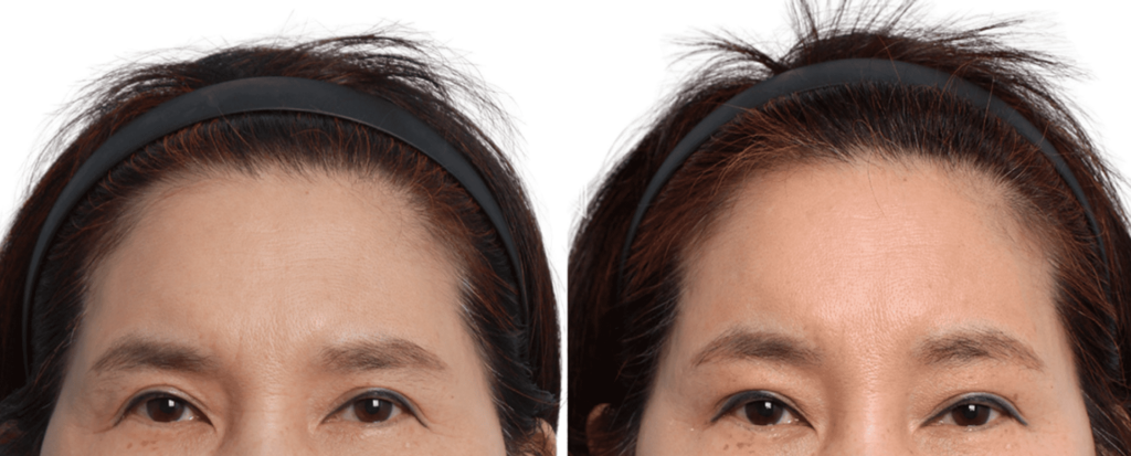 Forehead Lift_ Myths and Reality in Korea