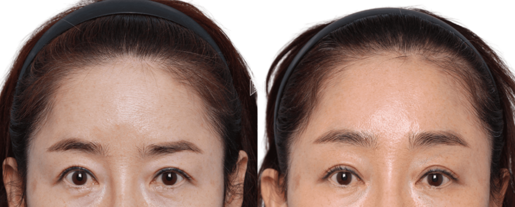 Forehead Lifting Methods in Korea