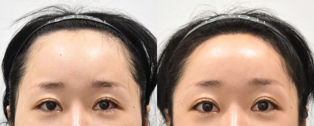 Forehead Reduction Surgery Procedure in Korea