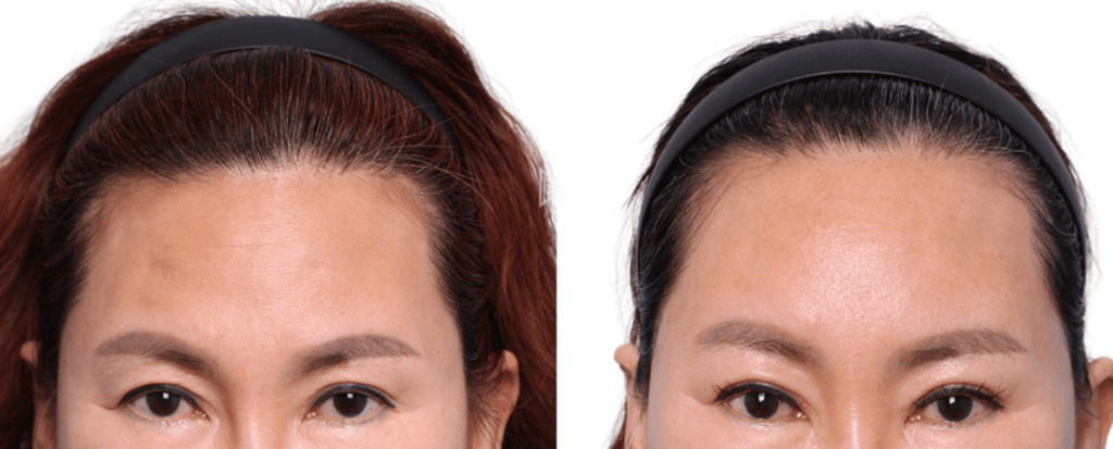 Forehead and Brow Lift in Korea