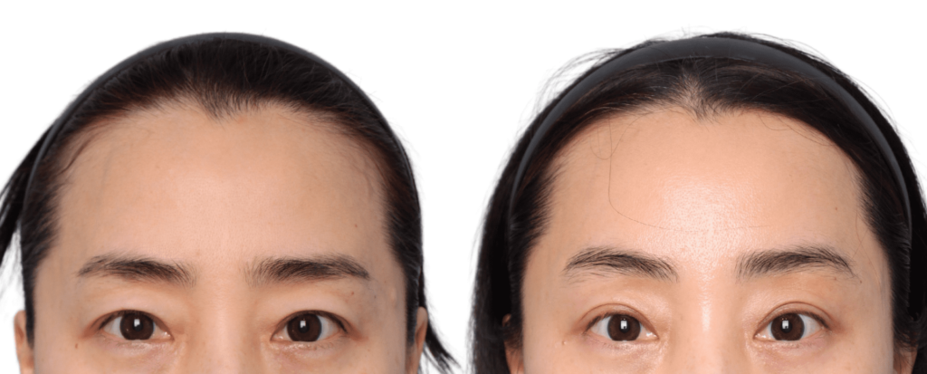 Forehead and Eyelid Lift in Korea