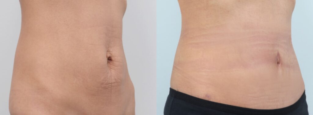 Frequently Asked Questions on Abdominoplasty in Korea