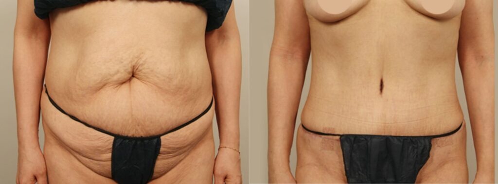 Full Abdominoplasty in Korea