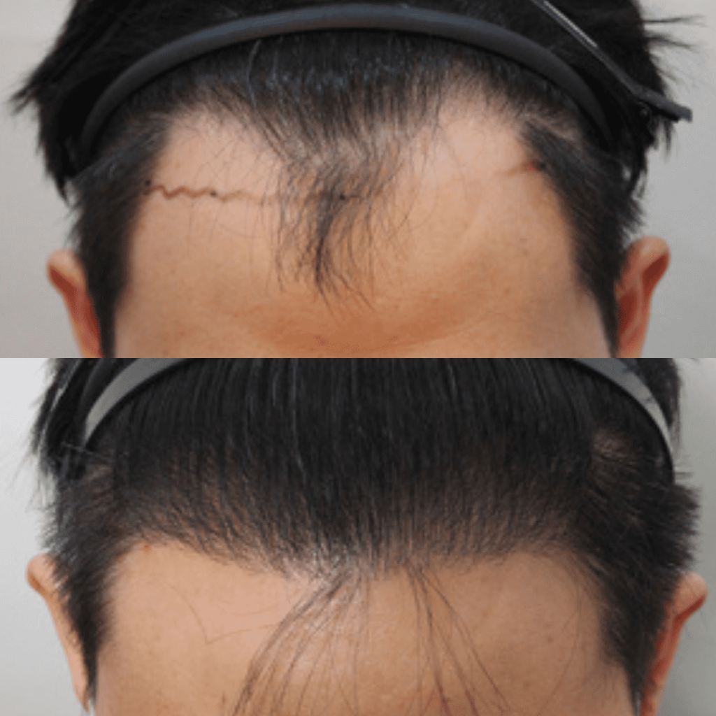 Future Trends in Hair Transplantation in Korea