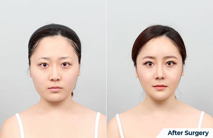 Getting Rid of a Square Jaw Shape in Korea