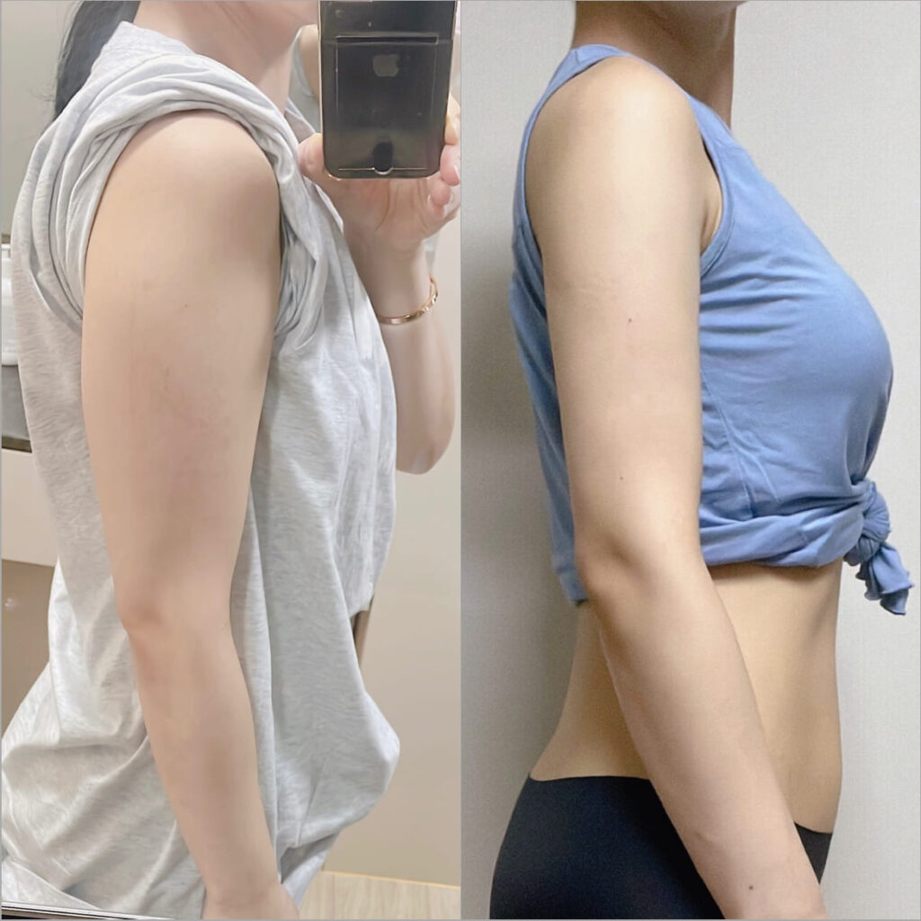 Guarantees After Arm Liposuction in Korea