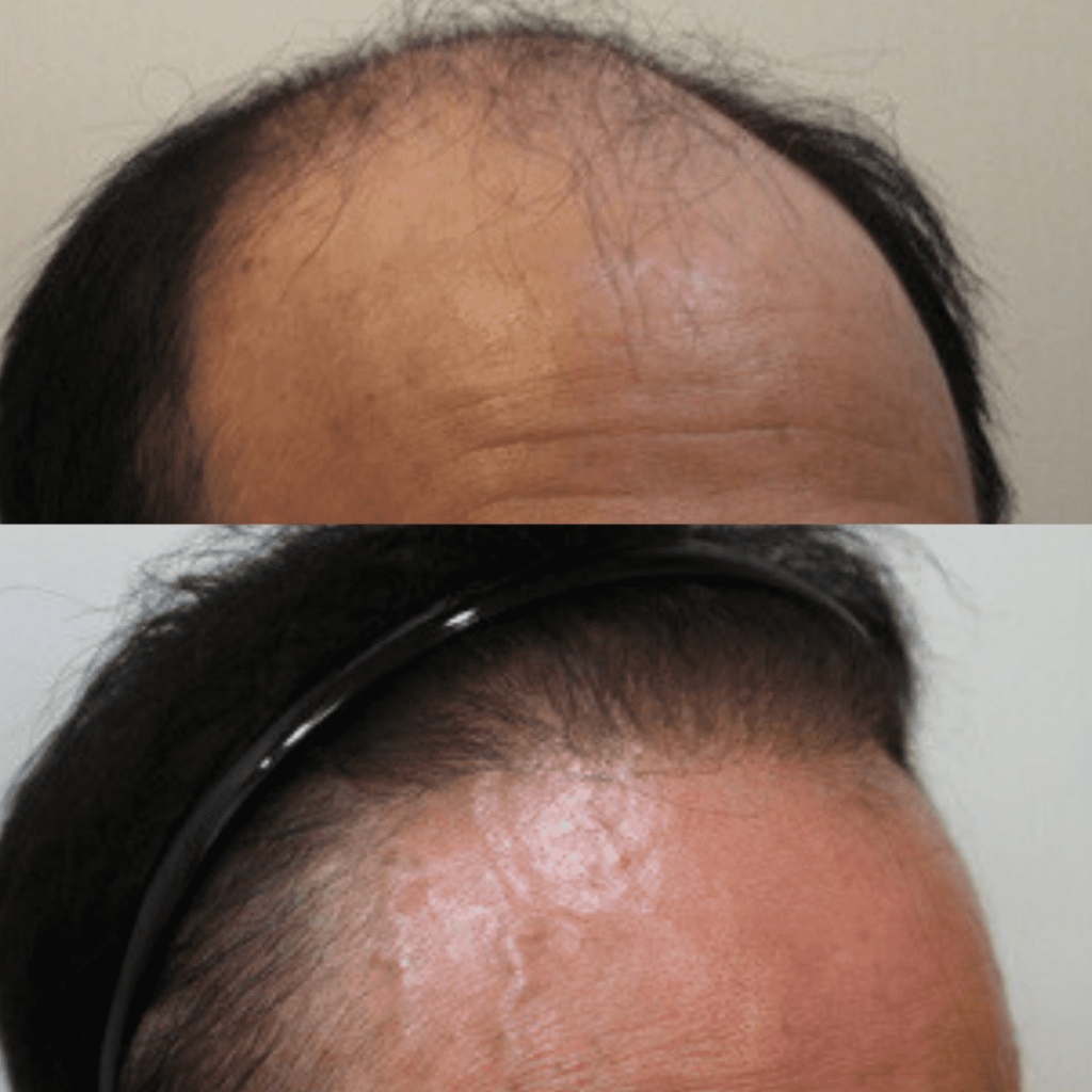 Hair Restoration Explained_ Step-by-Step Guide in Korea