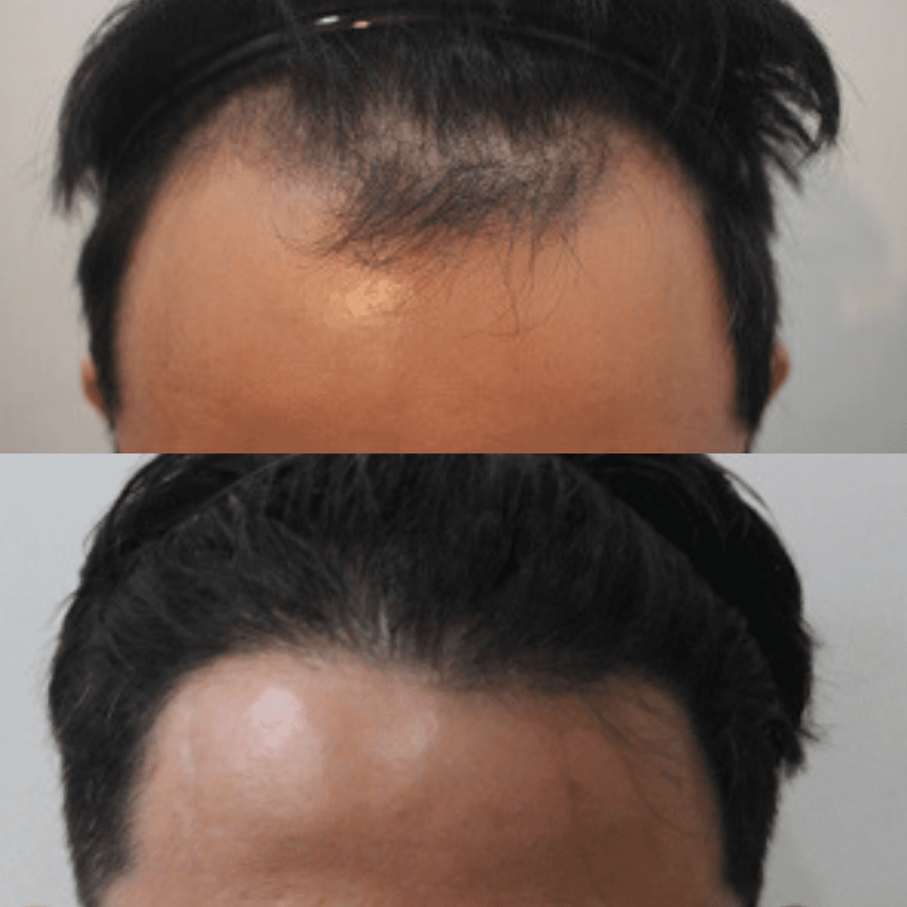 Hair Transplant Process and Results in Korea