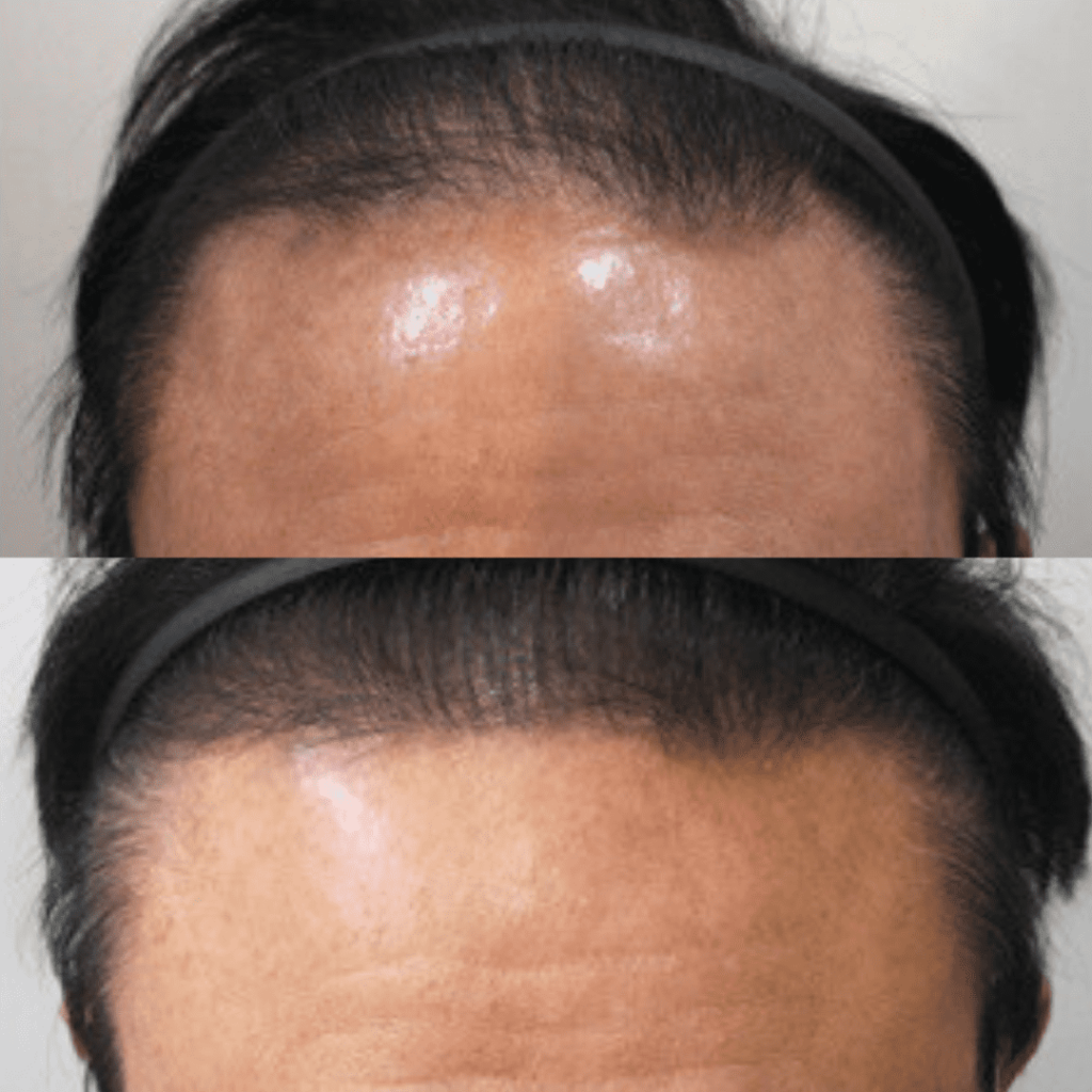 Hair Transplantation Techniques Demystified in Korea