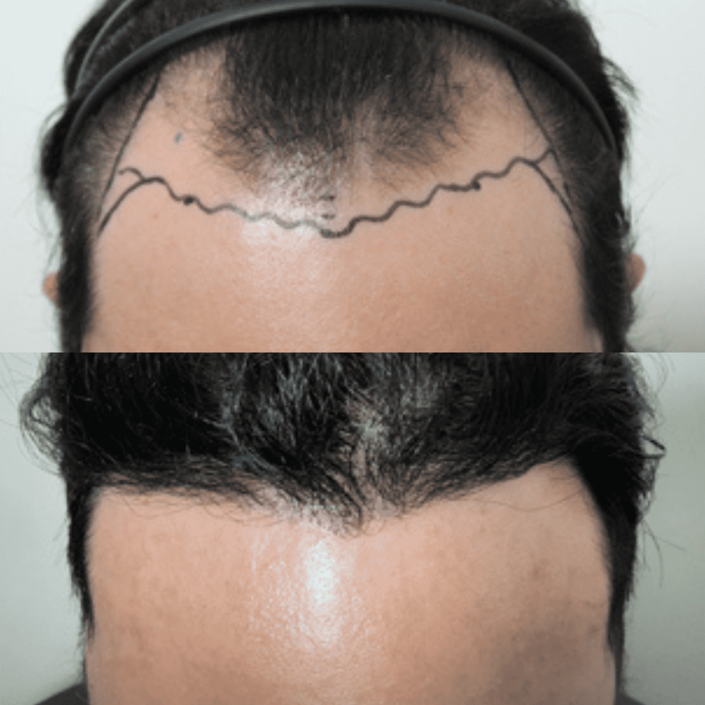 Hair Transplantation for Men_ Key Considerations in Korea