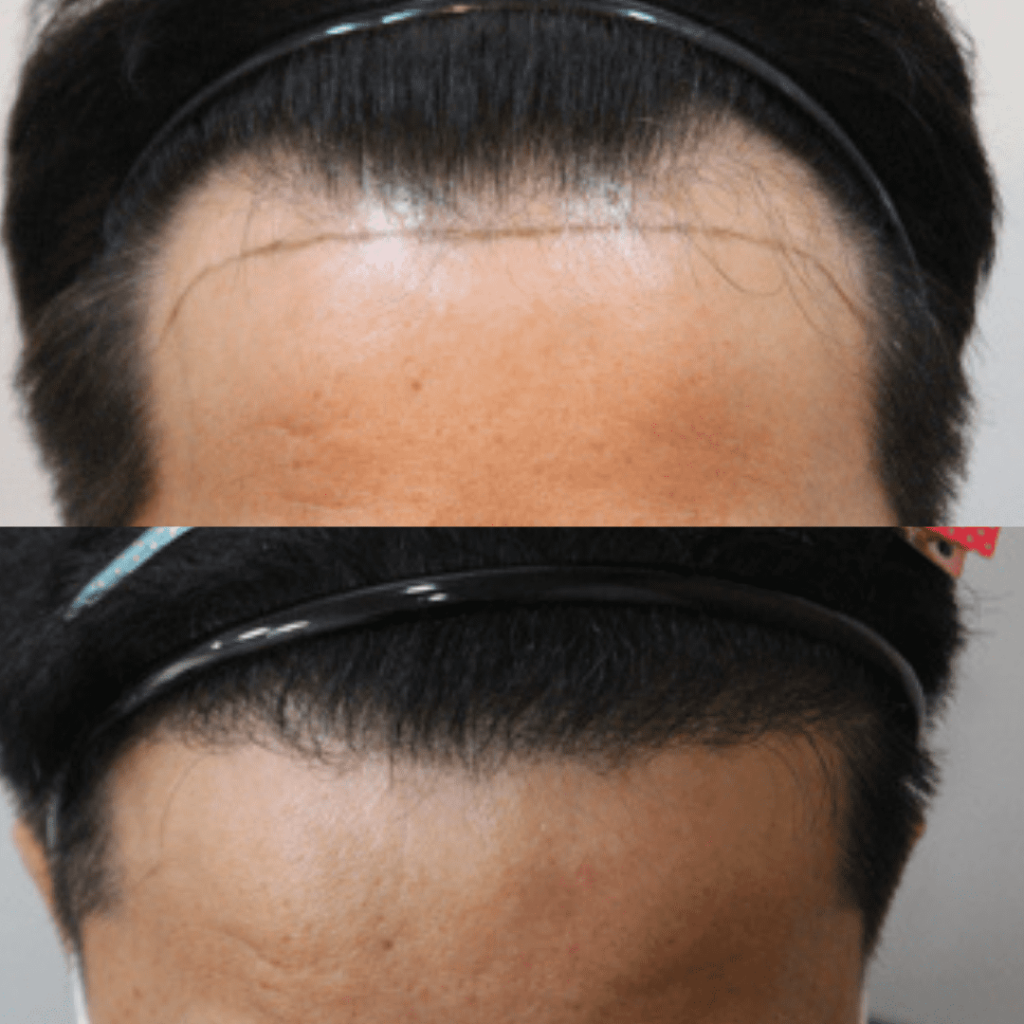 Hair Transplantation for Women_ Important Insights in Korea