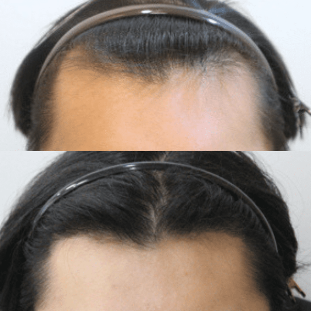 Hair Transplantation_ A Closer Look at Recovery in Korea