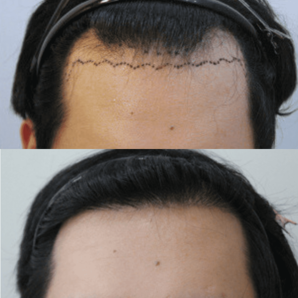 Hair Transplantation_ A New Beginning in Korea