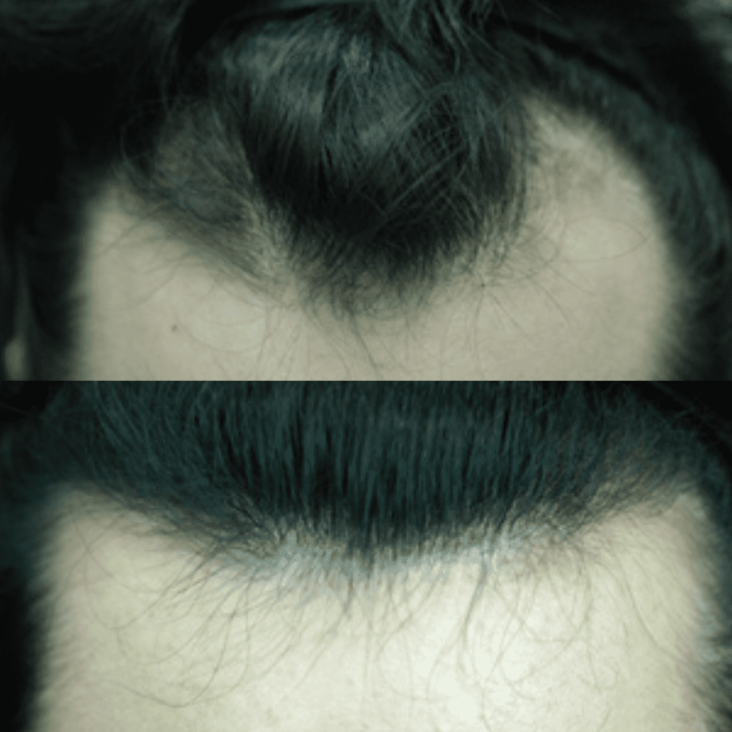 Hair Transplantation_ A Permanent Solution in Korea