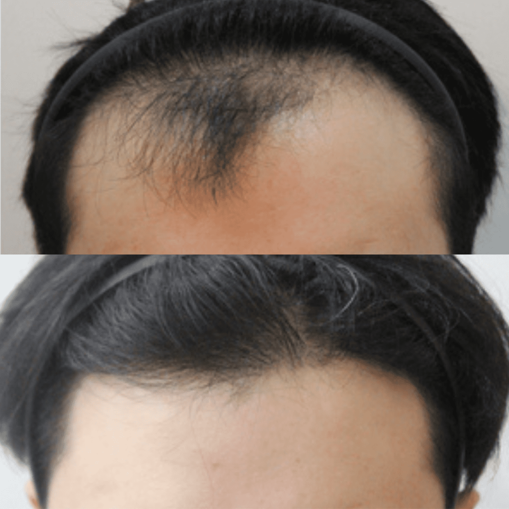 Hair Transplantation_ A Permanent Solution to Baldness in Korea