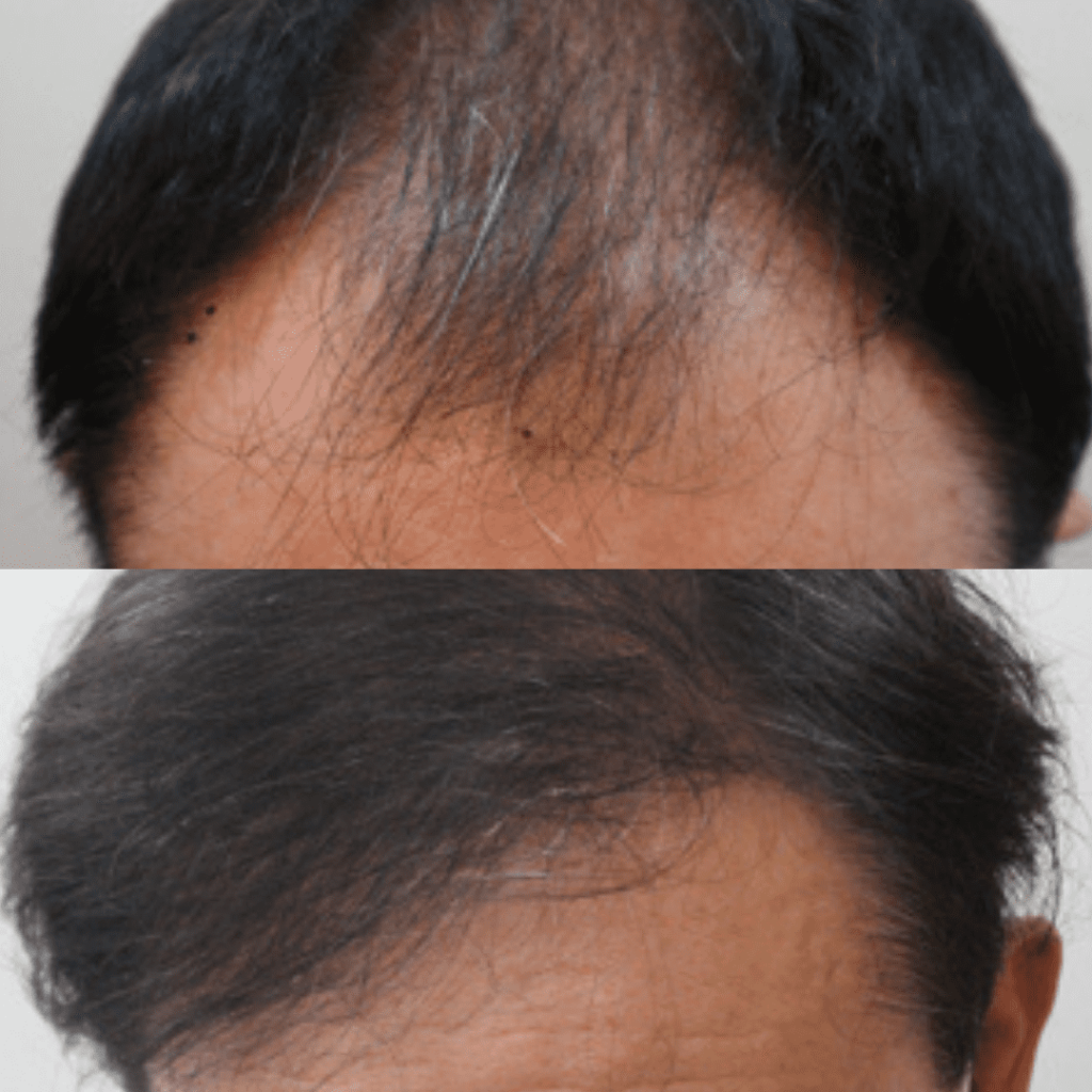 Hair Transplantation_ A Step Closer to Confidence in Korea