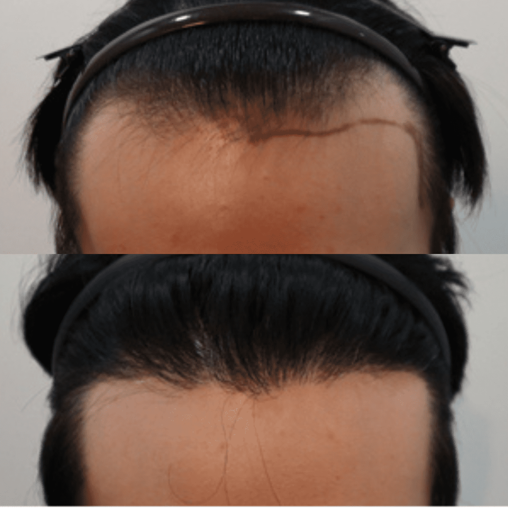 Hair Transplantation_ Addressing Hair Thinning in Korea