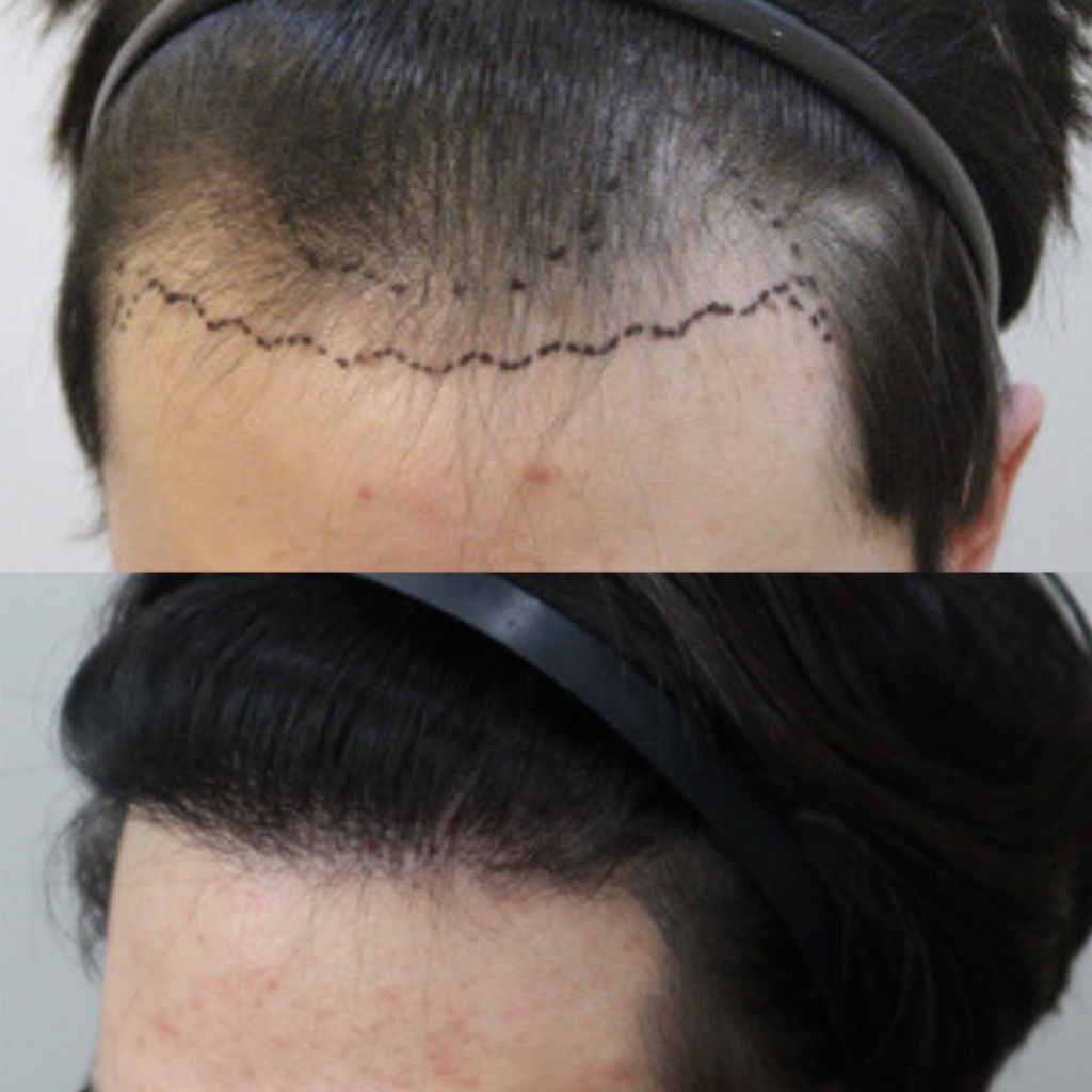 Hair Transplantation_ Addressing Receding Hairline in Korea