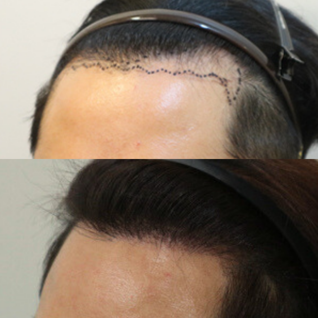 Hair Transplantation_ Enhancing Quality of Life in Korea