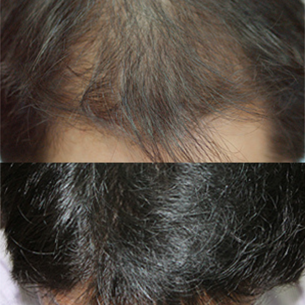 Hair Transplantation_ Lifestyle Tips for Healthy Hair in Korea