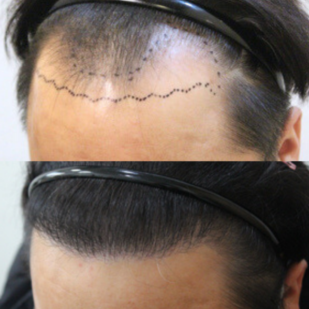 Hair Transplantation_ Transforming Lives in Korea