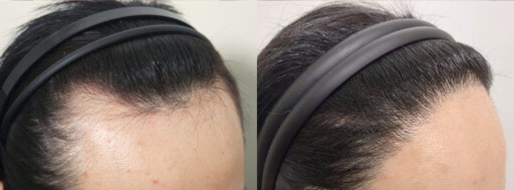 Hair restoration for women in Korea