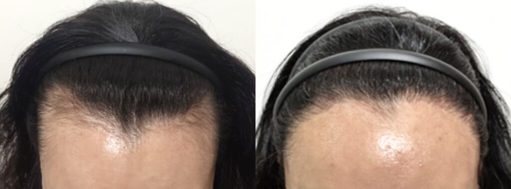 Hair transplant for women_ facts and myths in Korea