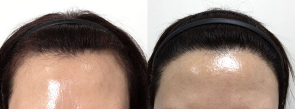 Hair transplant for women_ frequently asked questions in Korea