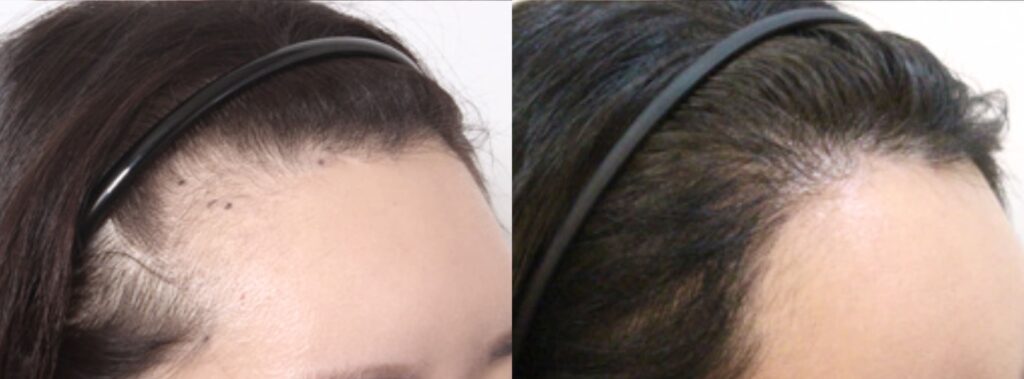 Hair transplant for women_ path to beauty in Korea