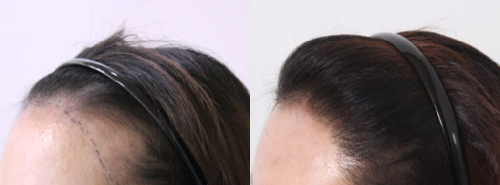 Hair transplant for women_ reviews and results in Korea