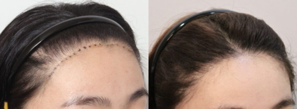 Hair transplant_ change in woman_s life in Korea