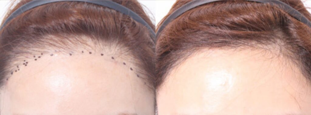 Hair transplant_ key to female confidence in Korea