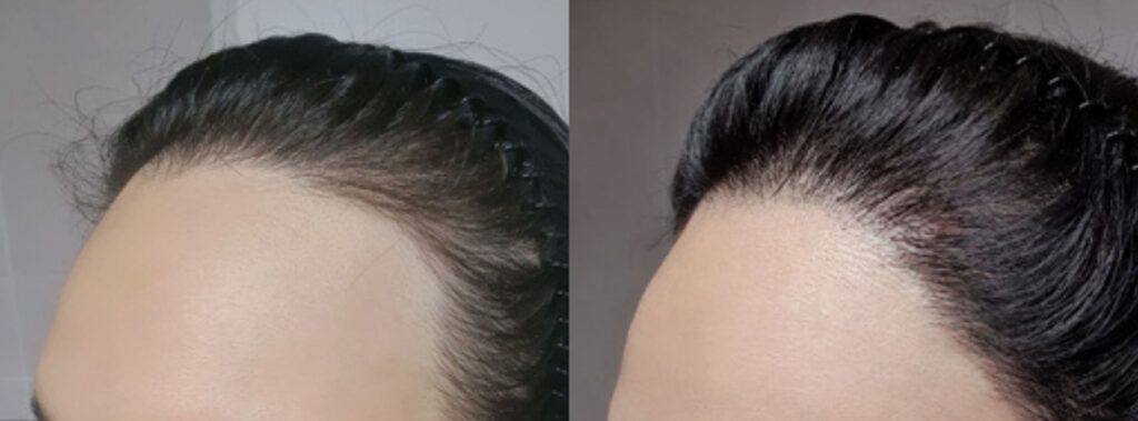 Hair transplant_ new life for women in Korea