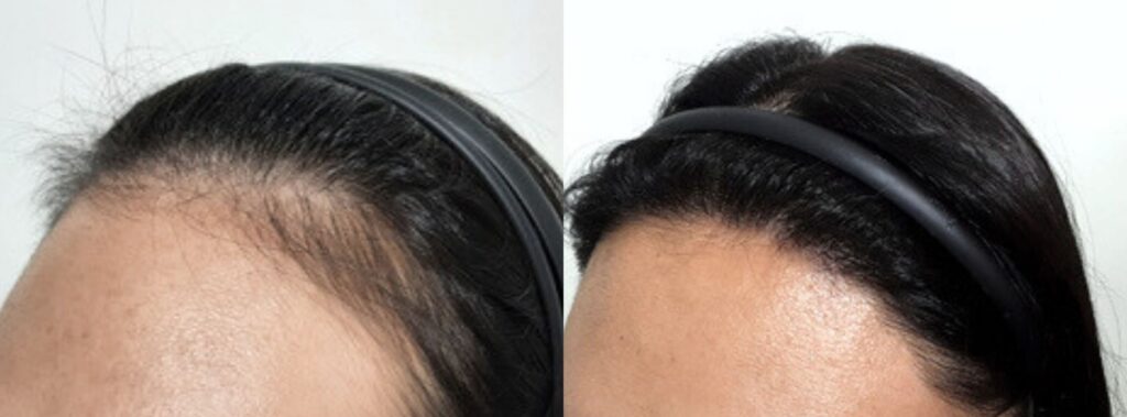 Hair transplant_ path to beauty for women in Korea