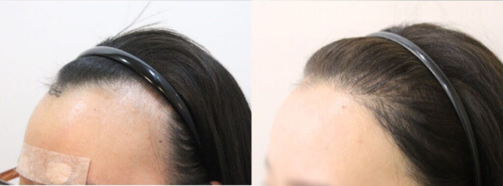 Hair transplant_ secret of female allure in Korea