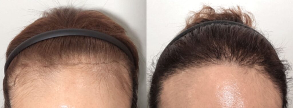 Hair transplant_ secret to female attractiveness in Korea