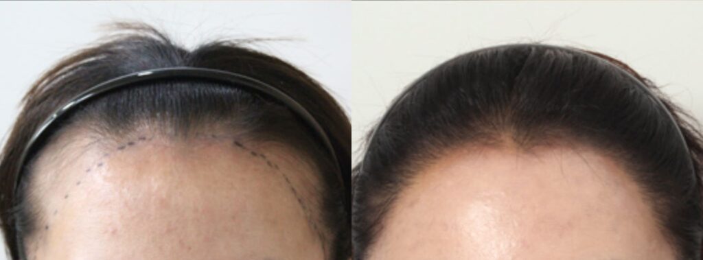 Hair transplant_ solution to women_s hair problems in Korea