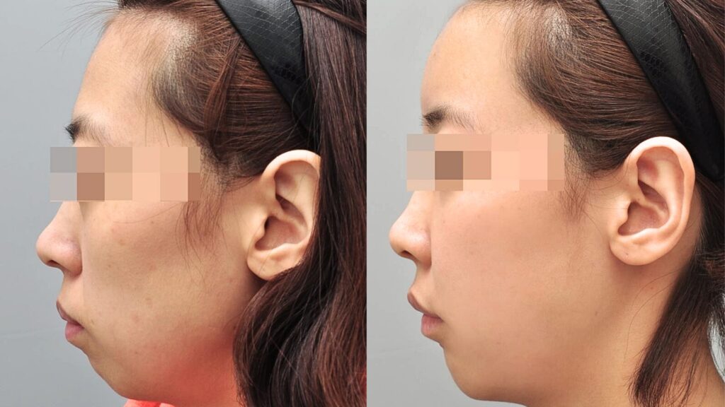 How Facial Lipofilling is Done