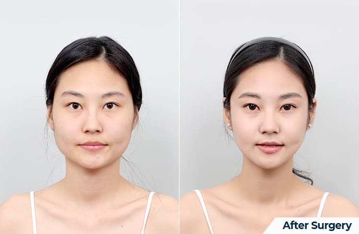 How to Change Your Face Shape with V-line Surgery in Korea