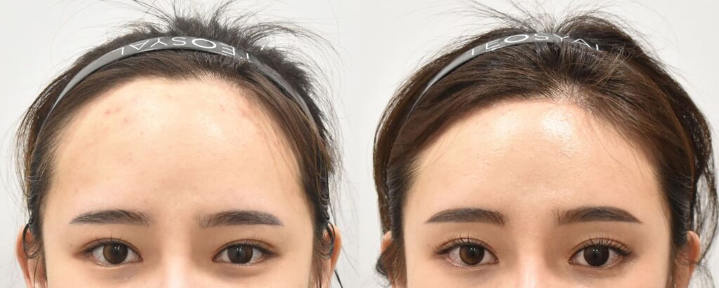 How to Reduce Forehead Size Non-Surgically in Korea