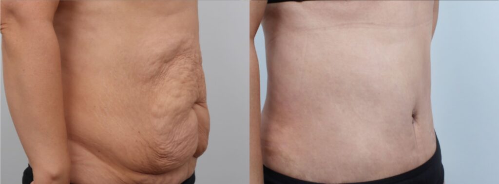 Ideal Candidate for Abdominoplasty in Korea