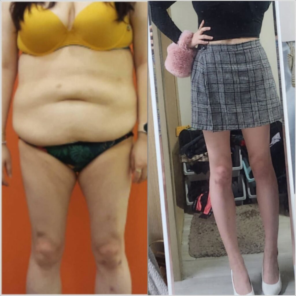 Ideal Candidates for Abdominal Liposuction in Korea