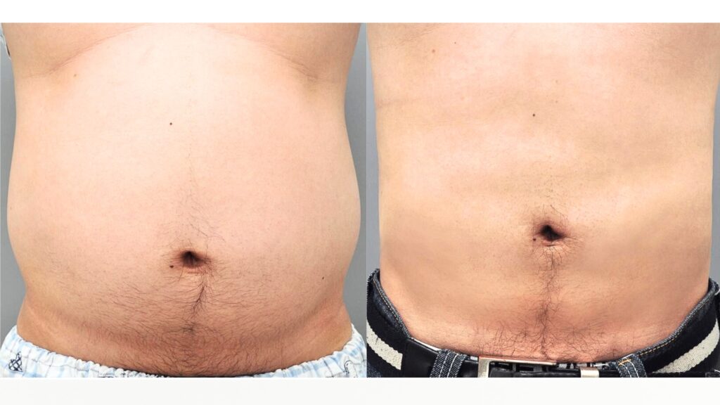 Importance of Consultation for Abdominal Liposuction in Korea