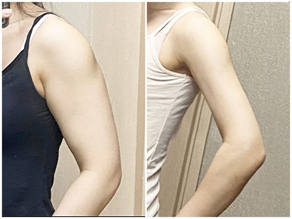 Important Aspects of Arm Liposuction in Korea