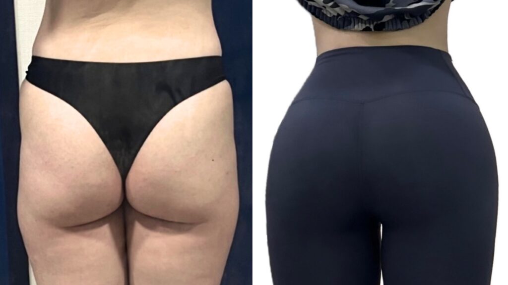 Improving Body Contours Through Buttock Lipofilling in Korea